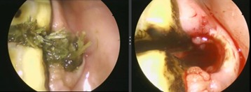 A close up image of a cavity in the horse's gum which is filled with chewed hay/grass. Once, removed, the remaining hole is sore and bloody.